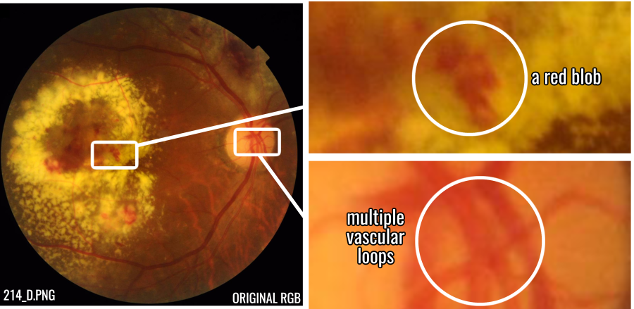 A colour retinal fundus photograph with two boxed regions enlarged alongside it. One enlargement marks a red lesion as a connected blob; the other marks several loops in the retinal vasculature.